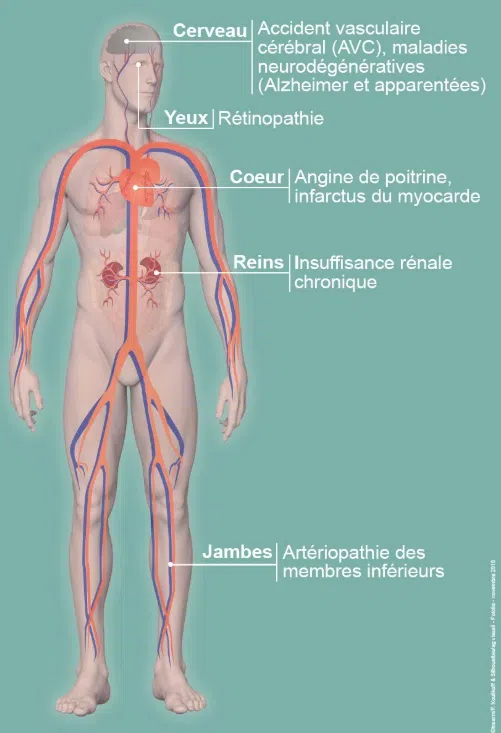 Les principales complications associées à l'hypertension artérielle