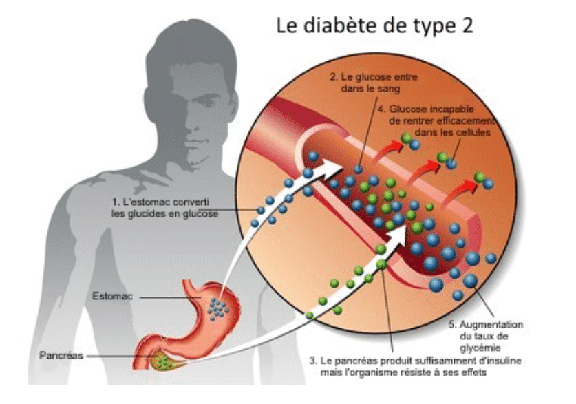 Le diabète de type 2
