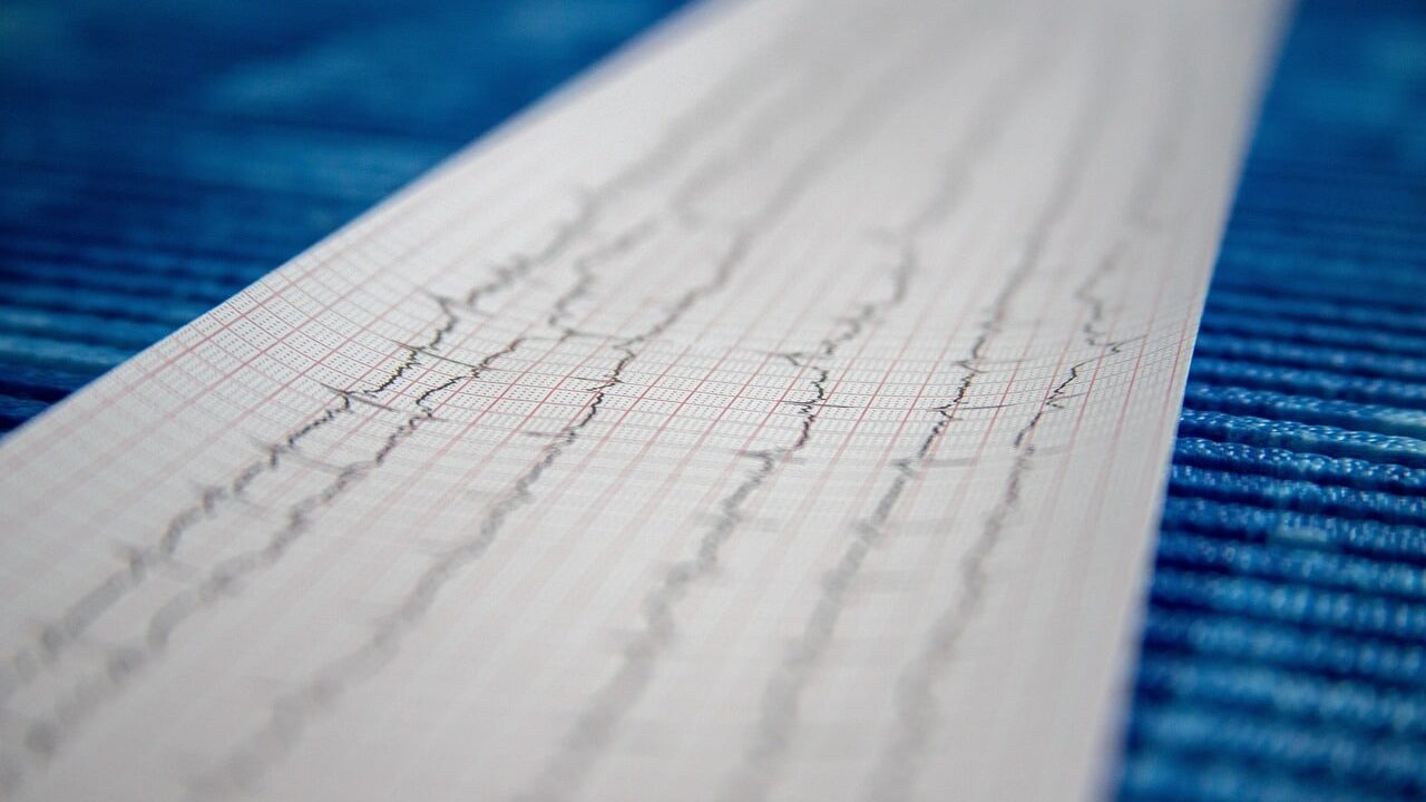 L'accident vasculaire cérébral (AVC)